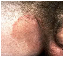 jock itch treatment for men