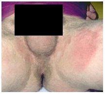 jock itch treatment for women